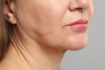 Gloderm